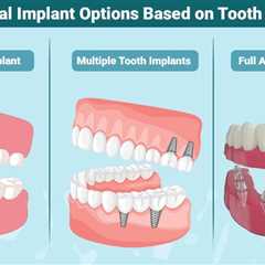 Dental Implant